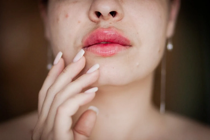 Featured image for “Radiesse vs Juvederm: Which Dermal Filler is Right for You?”