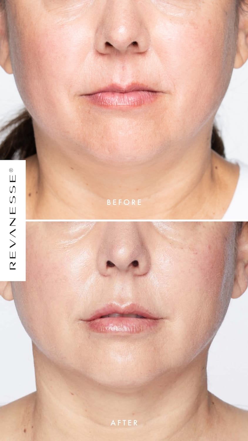 Before and after Revanesse dermal filler