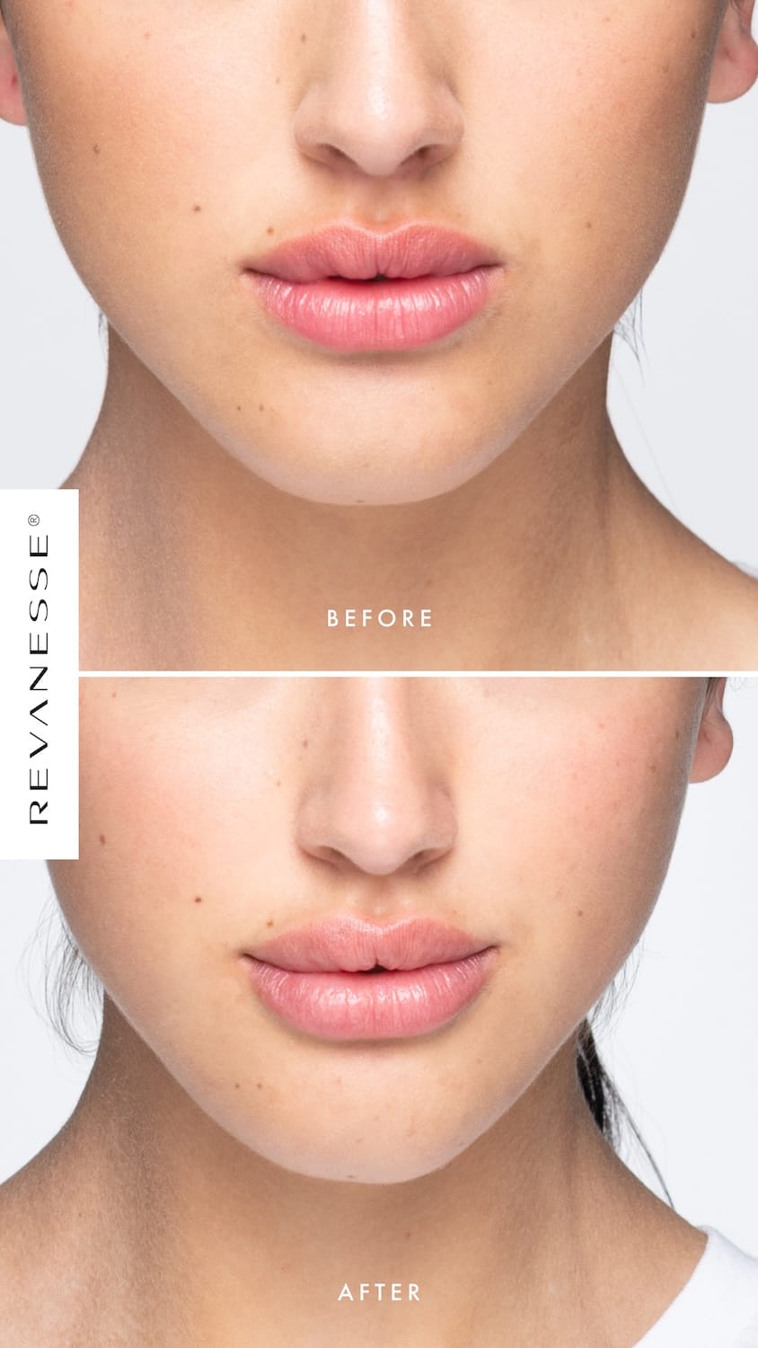 Before and after Revanesse Lips+ treatment