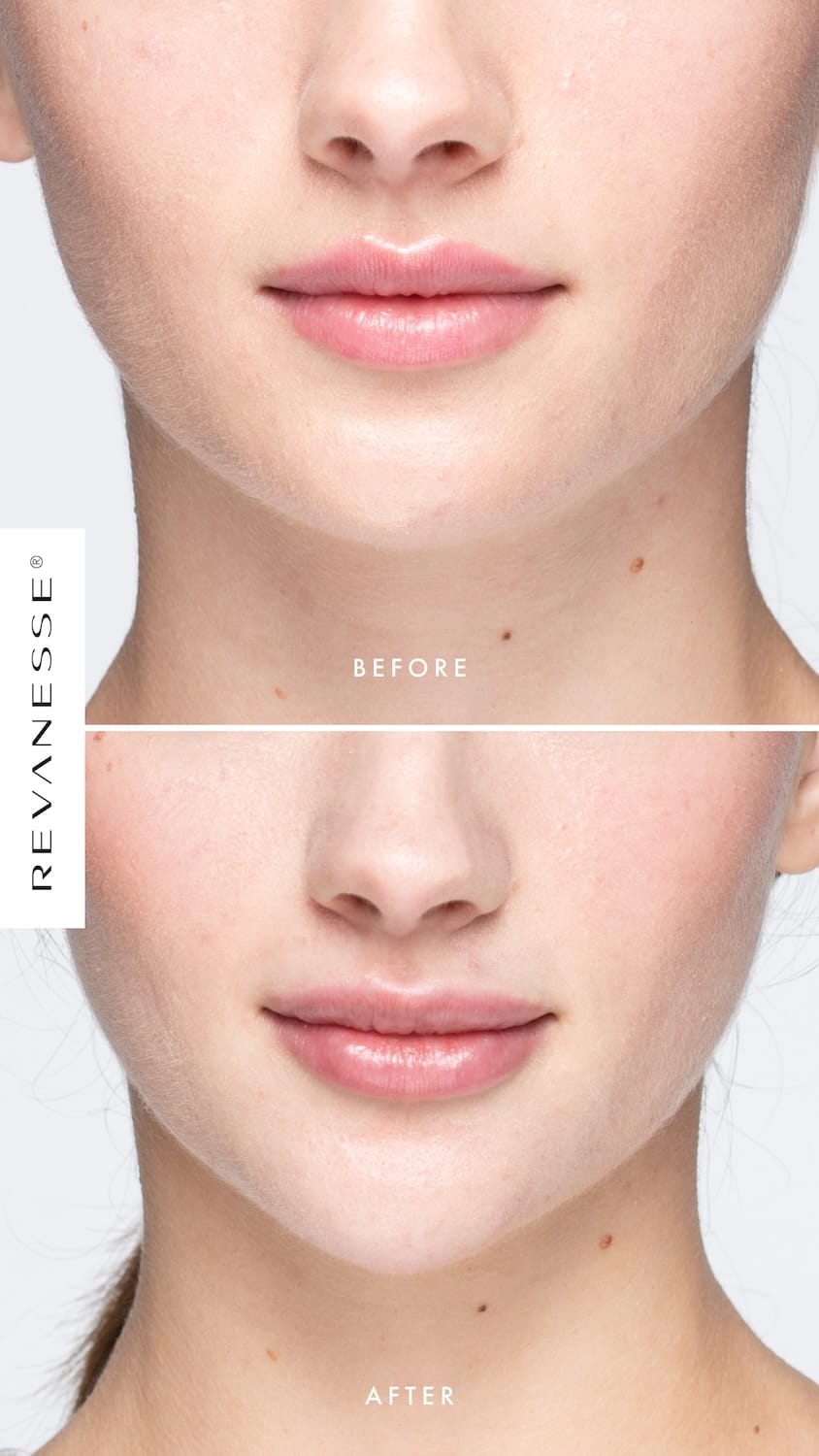 Before and after Revanesse Lips+ filler treatment 