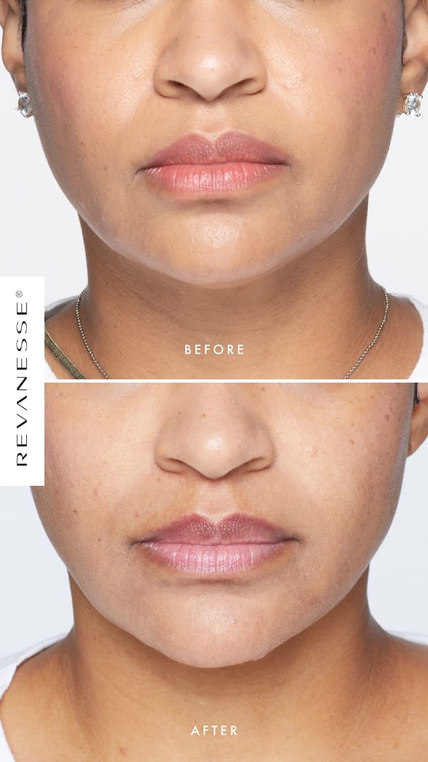 Before and after Revanesse Lips+ soft-volume filler
