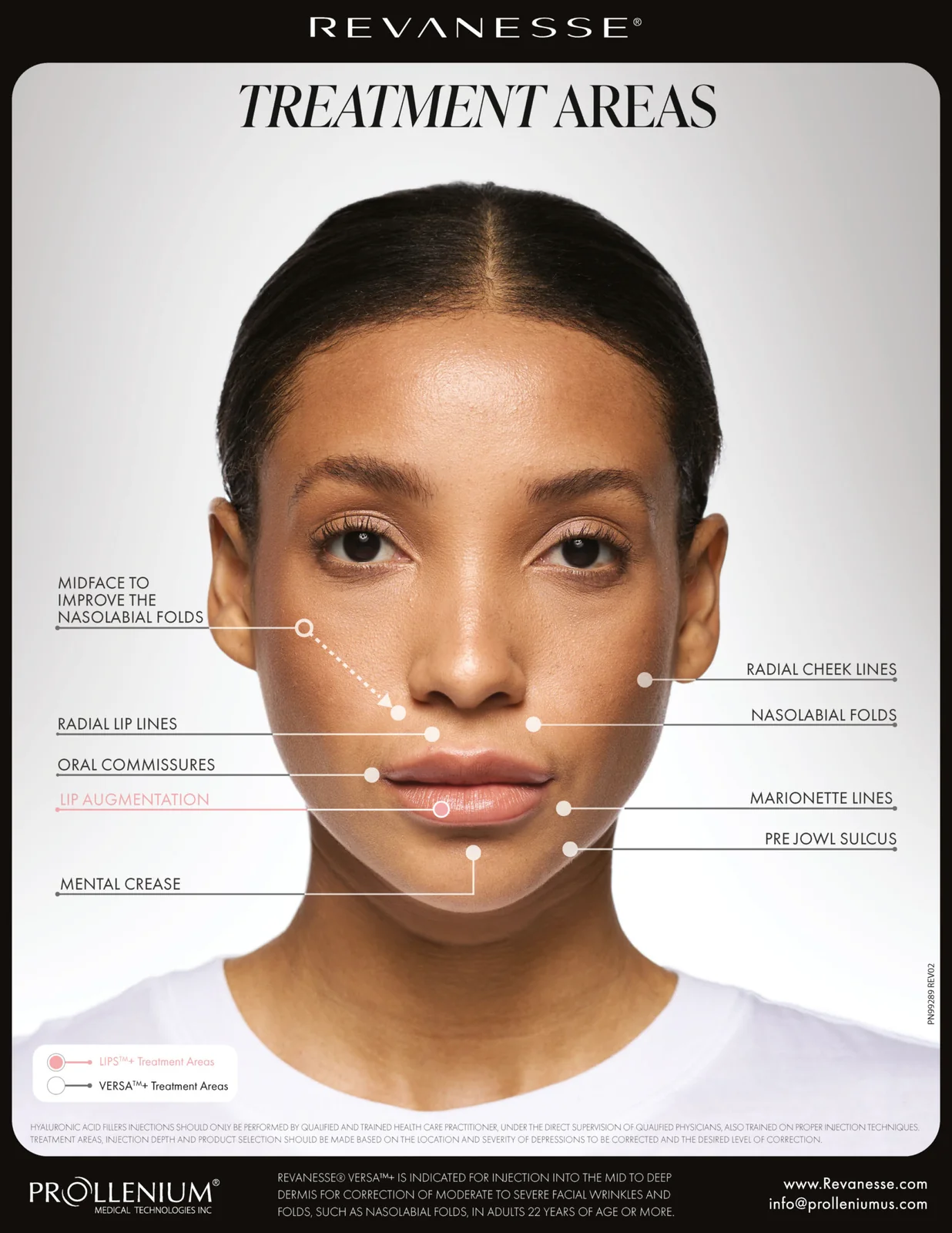 Diagram of facial treatment areas addressed with Revanesse Versa+ dermal filler at Express Med Spa, including cheeks, lips, nasolabial folds, and chin.