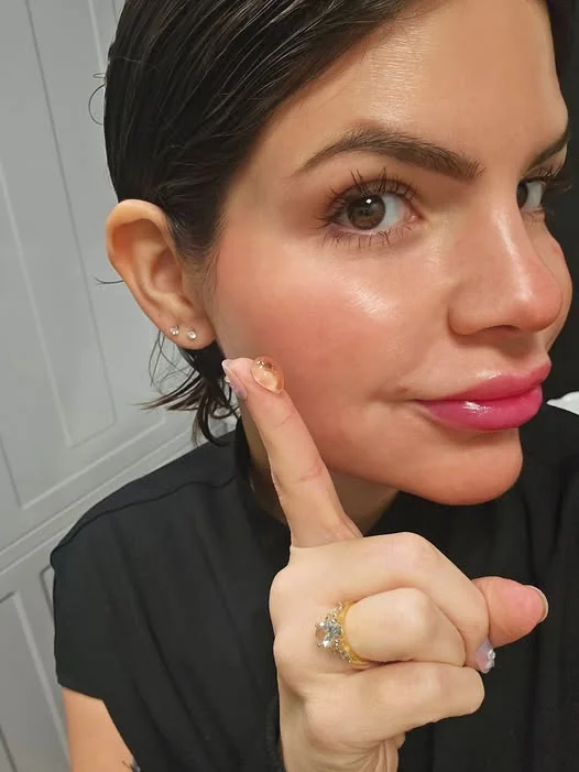 Express Med Spa registered nurse demonstrating Revanesse Versa+ dermal filler injection technique and volume at Express Med Spa.
