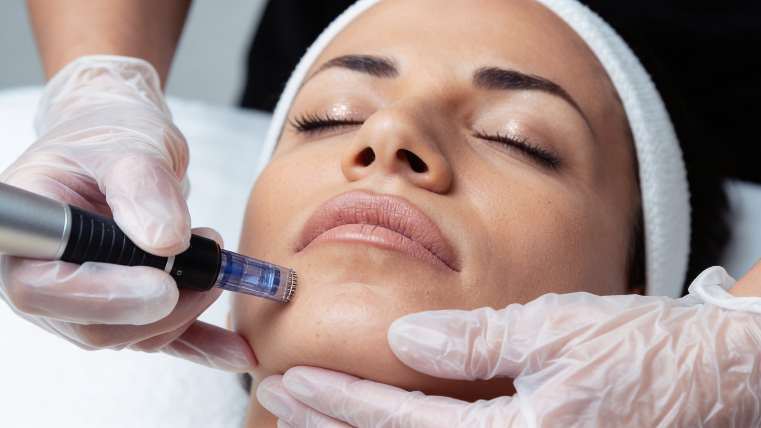 Does Microneedling Work For Acne Scars? microneedling skinpen treatment on chin for acne scars and skin rejuvenation in Illinois