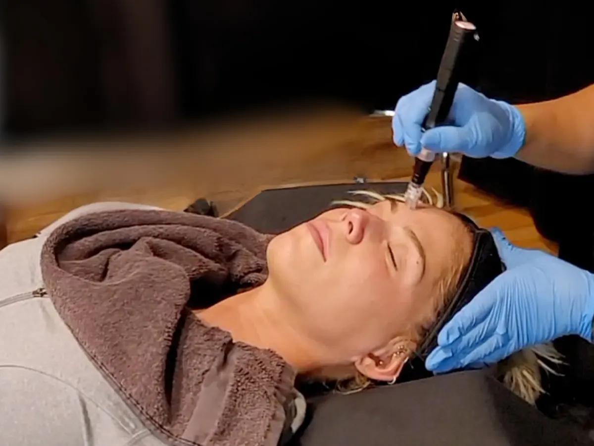 Sublative RF microneedling treatment in Shorewood IL improving laxity and fine lines with radiofrequency energy