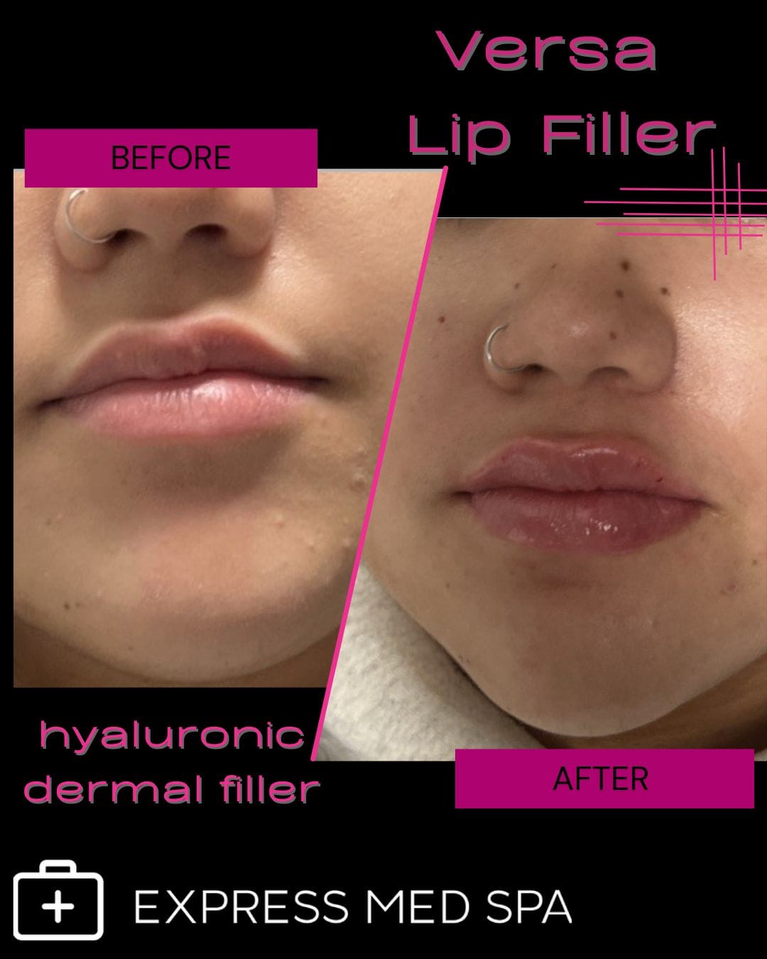 Before and After Versa Lip Filler