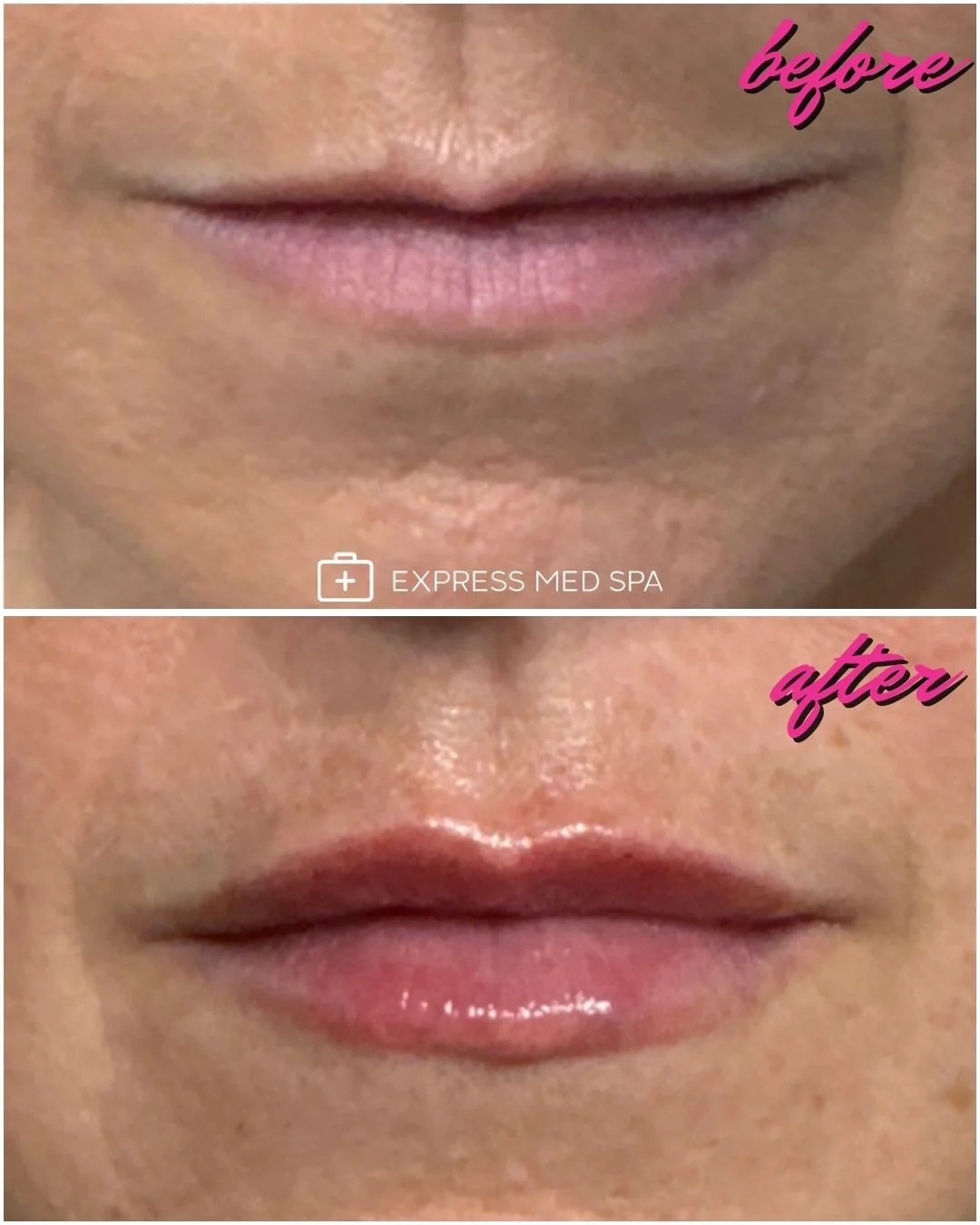 Before and after Versa lip filler at Express Med Spa in Frankfort, IL showing subtle added lip volume and a defined, natural shape.