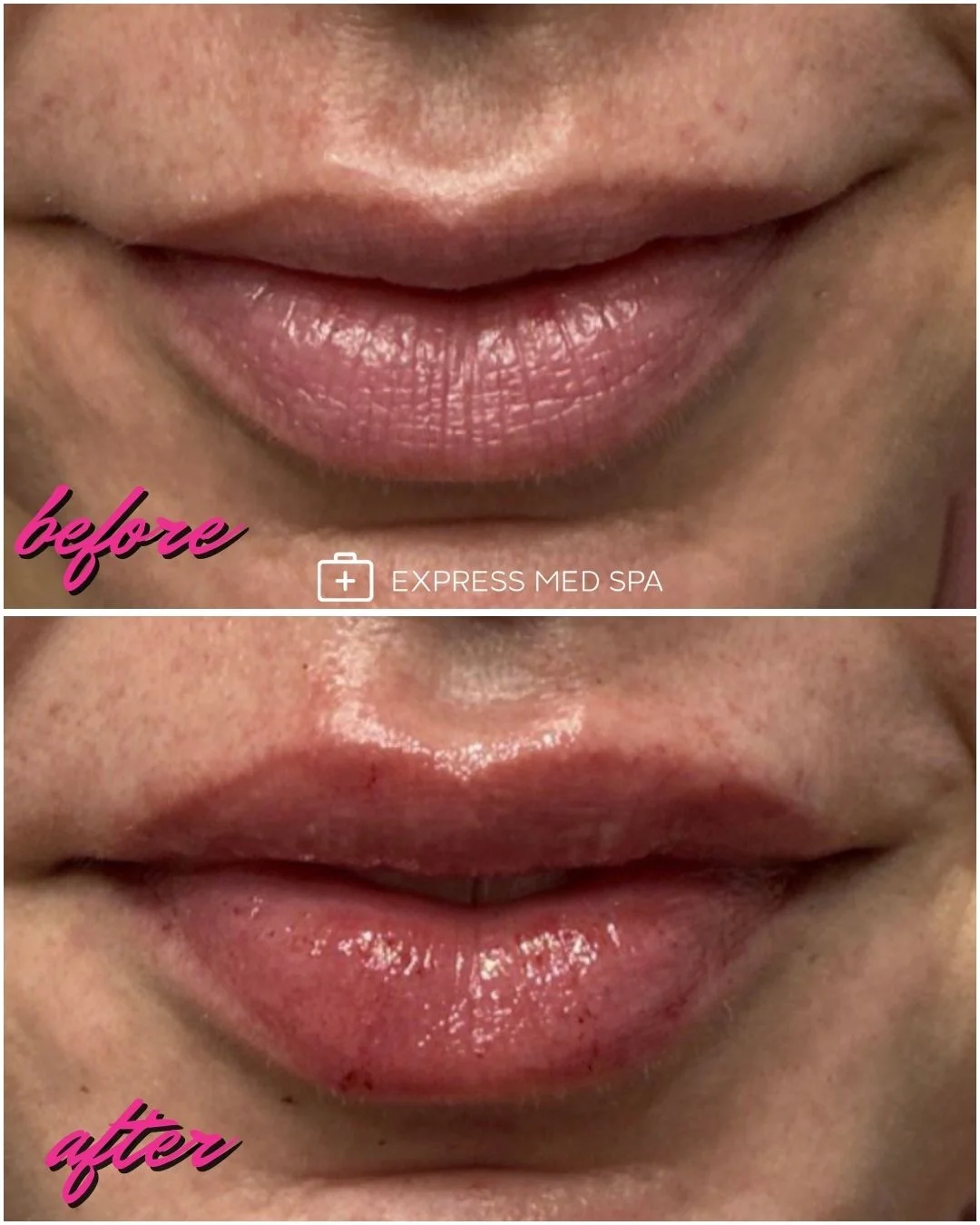 Before and after Versa lip filler at Express Med Spa showing softly enhanced lips with mild redness right after the injection appointment.