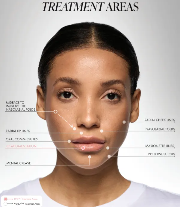 Versa Lip Filler treatment areas illustration showing lips and smile lines enhanced with natural balance at Express Med Spa La Grange IL
