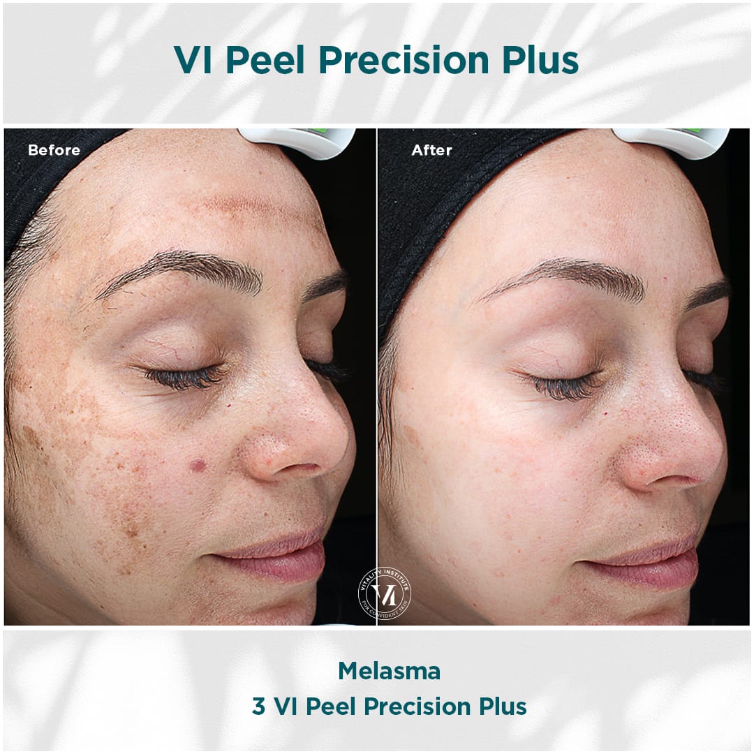 Close-up of a VI Peel being gently applied to the jawline by a licensed esthetician at Express Med Spa