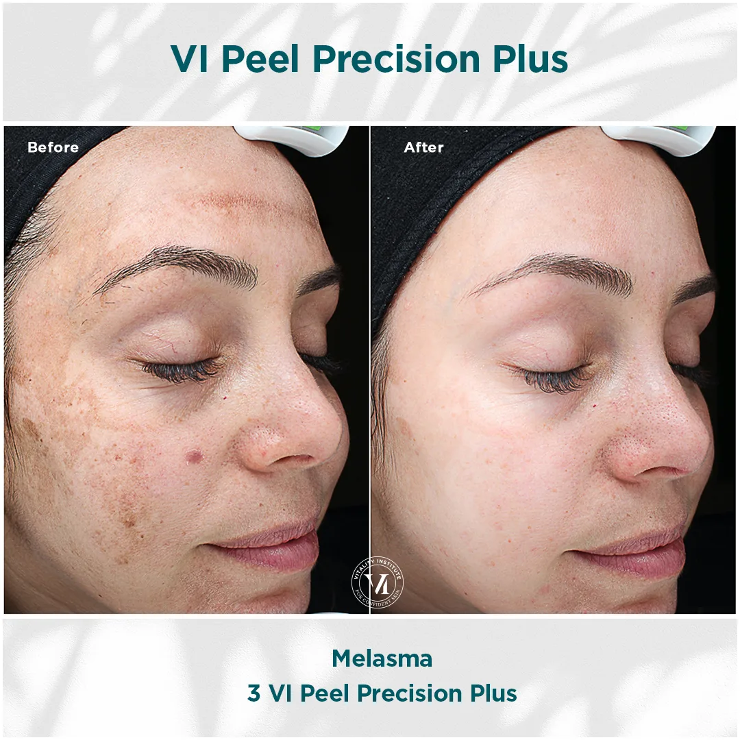Melasma improvement after 3 VI Peel Precision Plus treatments at Express Med Spas in Frankfort, IL.