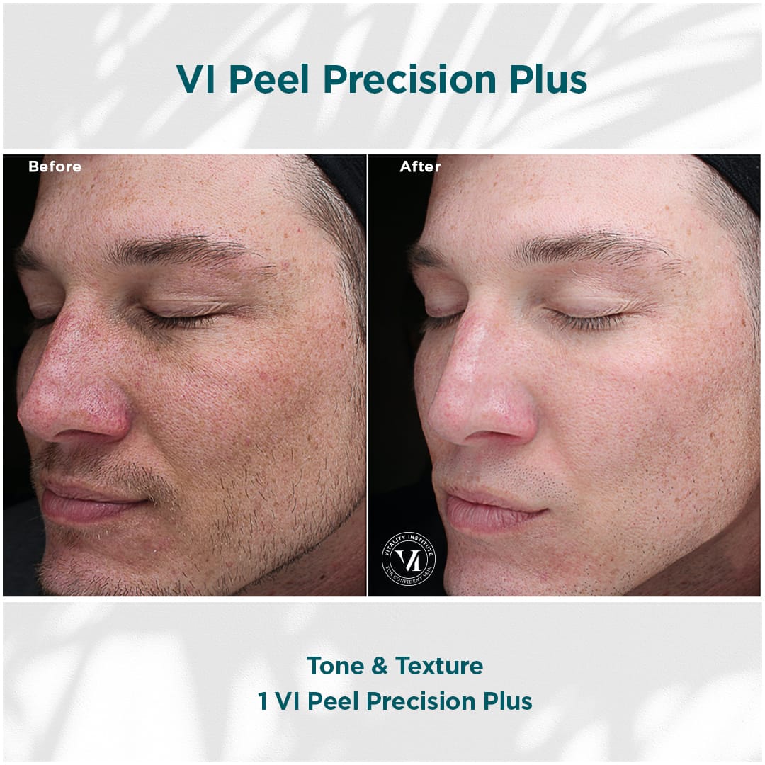 Underarm healing after VI Peel treatment showing redness and early exfoliation at Express Med Spa